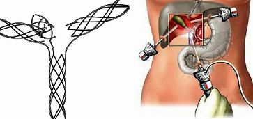 What Is A Biliary Stent? What Is The Function of Biliary Stent? Does The Gallbladder Want It?